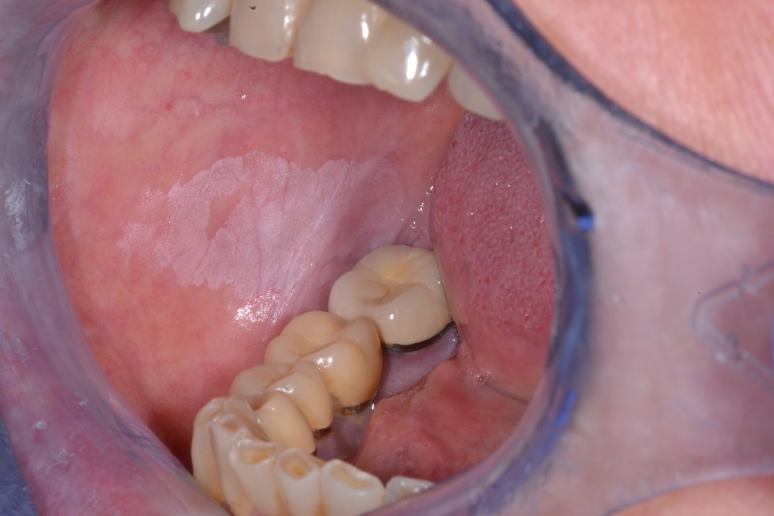 Leucoplasia Oral Opmdcare