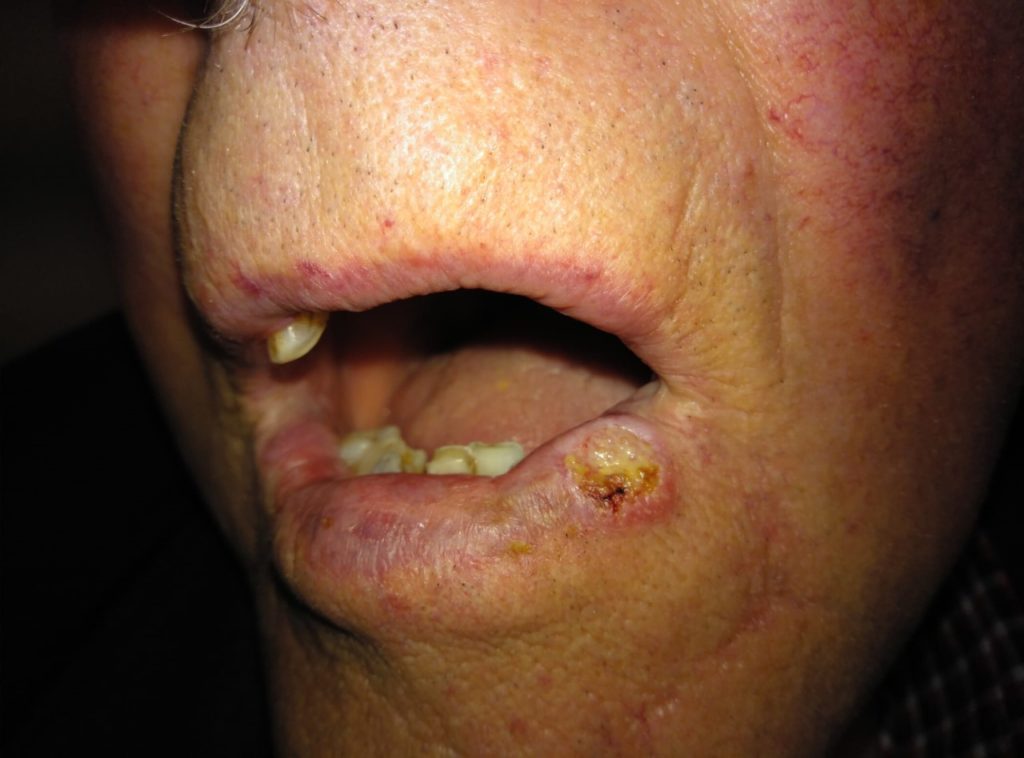 Figura 1: Carcinoma de células escamosas precedido por quilite actínica acometendo o lábio inferior. Os lábios aparecem secos e rachados, com indefinição entre o limite do lábio e a pele. Uma úlcera com bordas evertidas e endurecida à palpação é notada no lábio inferior esquerdo.
