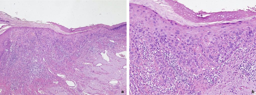 Figura 2: a) Hiperplasia epitelial con displasia, infiltrado inflamatorio crónico moderado y elastosis solar prominente y telangiectasia vascular en la submucosa (abajo a la derecha) (H&E, x4); b) A mayor aumento se observan áreas alternantes de paraqueratosis y ortoqueratosis, así como displasia epitelial, infiltrado linfocitario y elastosis. (HE, x10).