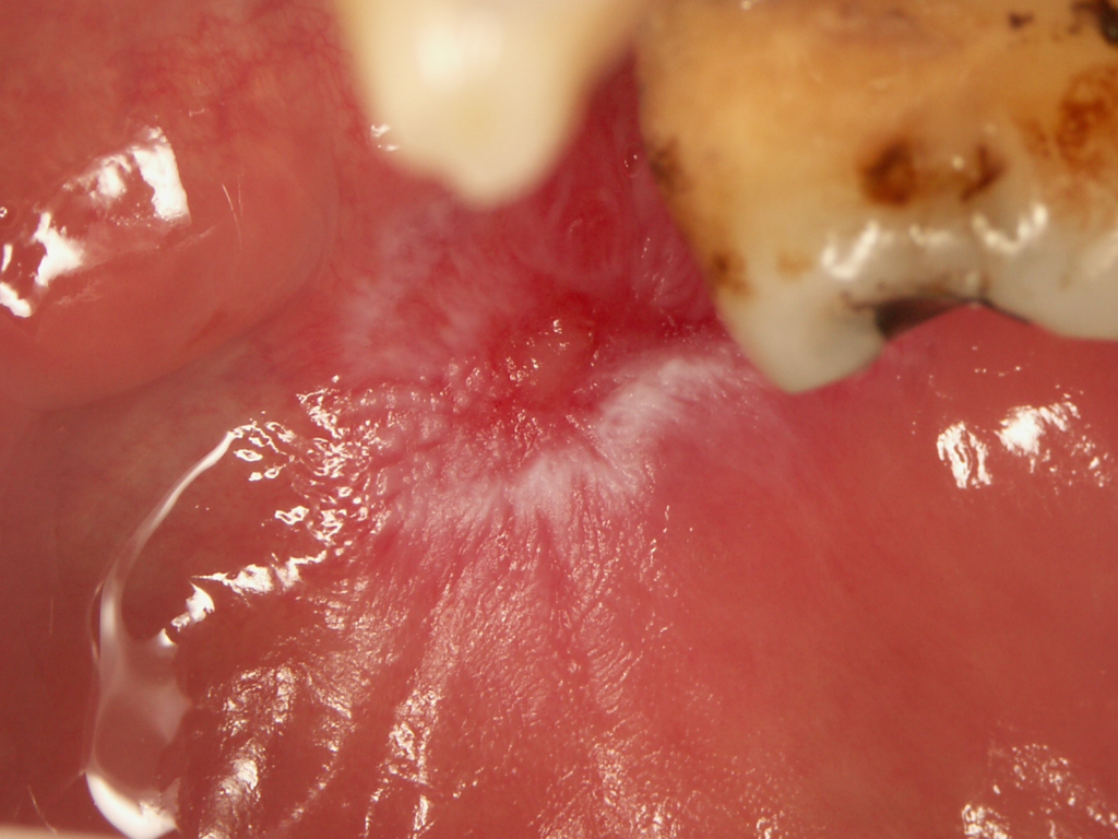 Slika 10. Lezija DLE-a na oralnoj sluznici sa središnjom atrofijom okruženom zrakastim hiperkeratotičnim strijama (ljubaznošću profesora Ivana Alajbega)
