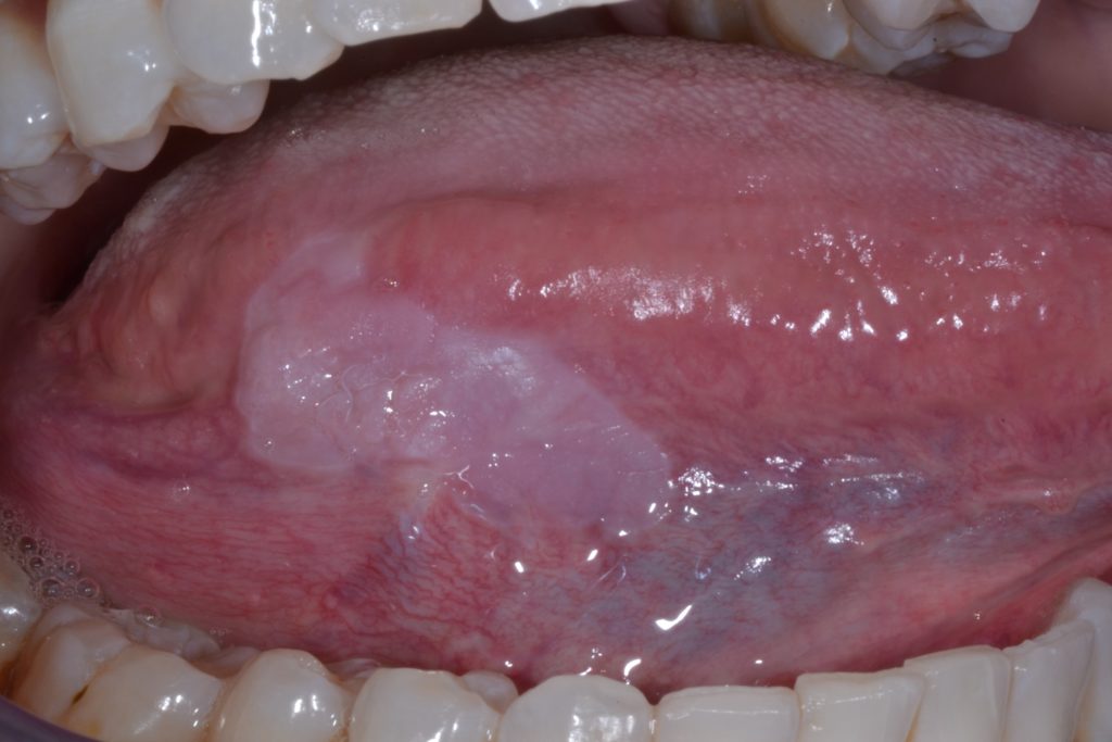 Figura 1: Leucoplasia homogénea en el borde lateral derecho de la lengua