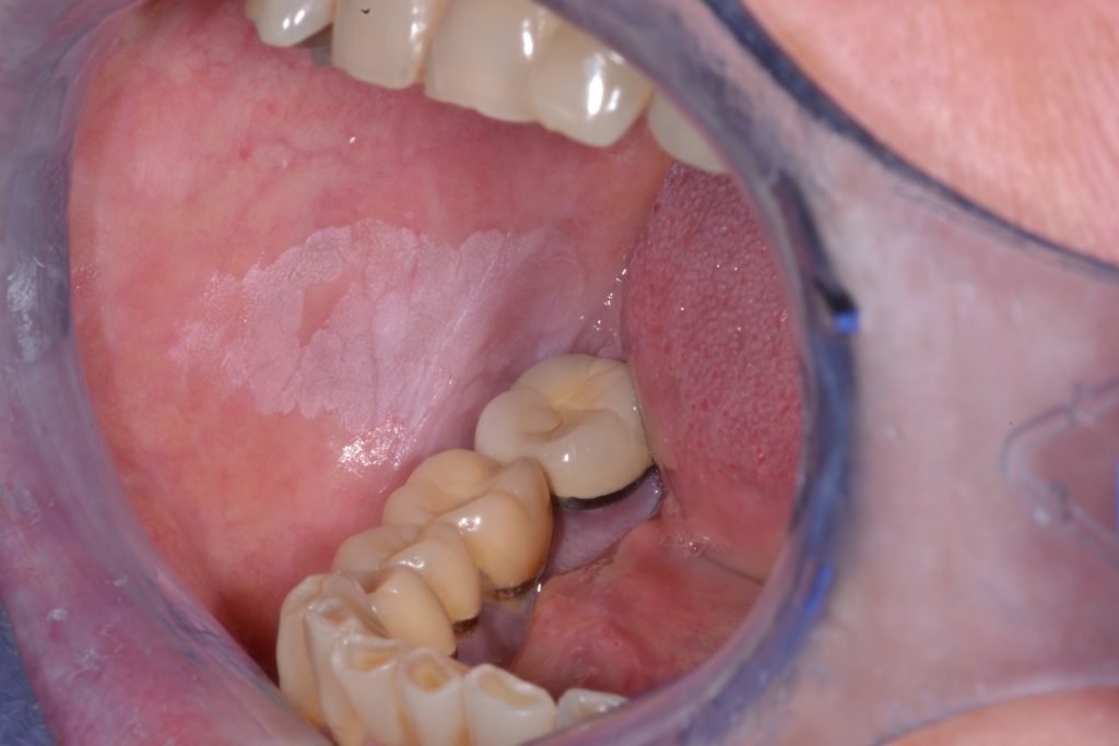 Figura 3: Leucoplasia homogénea en mucosa yugal derecha