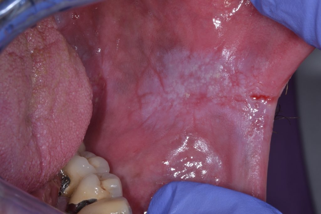 Figure 4 : Leucoplasie non homogène avec des composants verruqueux et nodulaires affectant la muqueuse buccale gauche.
