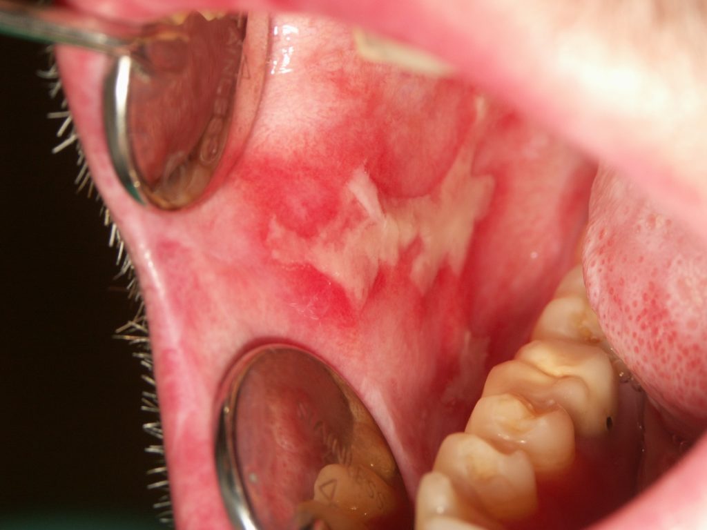 Figure 1. Lésion ulcérée affectant la muqueuse buccale chez un patient souffrant de GVHD chronique.