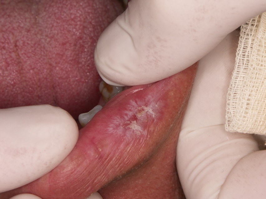Figure 1: Lip lesion in DLE presenting with central atrophy surrounded by radiating hyperkeratotic striae (courtesy of Professor Ivan Alajbeg)