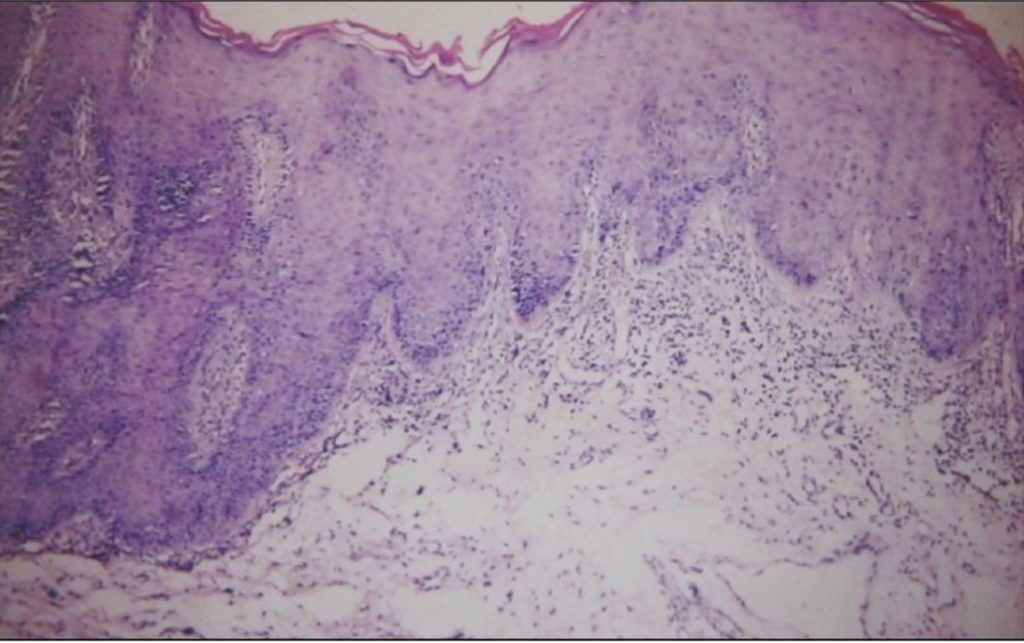 Figure 3: Histology of DLE presenting with hyperkeratotic, acanthotic stratified squamous epithelium, juxtaepithelial cell-free zone and vasodilation and oedema in the connective tissue (H and E stain, 450×) (image reproduced from Lallas et al, 2013 11).
