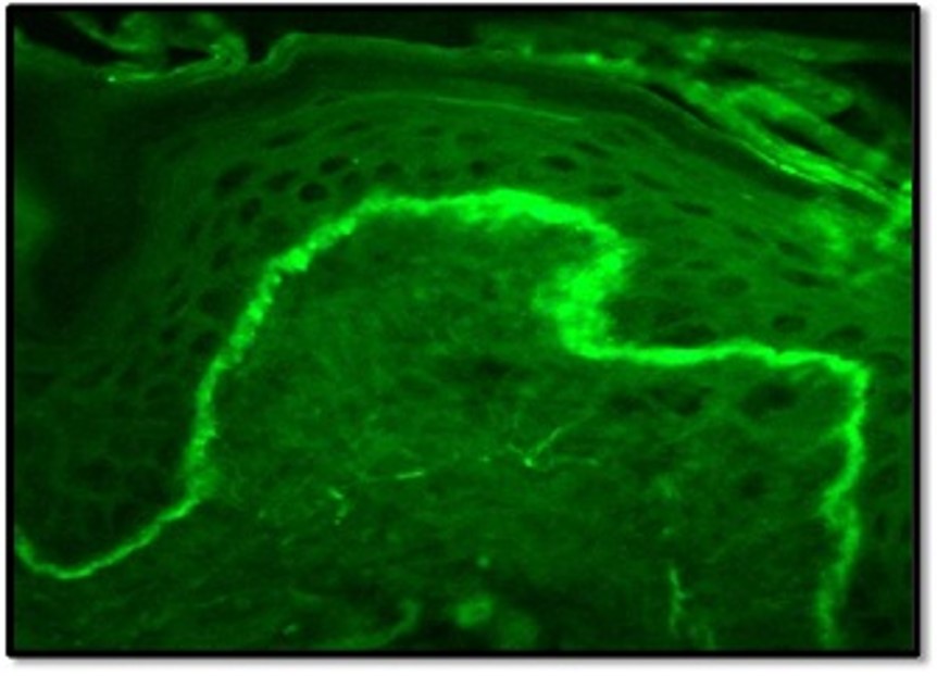 Figure 4: Direct immunofluorescence (DIF) of DLE showing deposit of IgM in a linear granular pattern at basement membrane zone (lupus band) (Image reproduced from Bhushan et al, 2017 (28)).