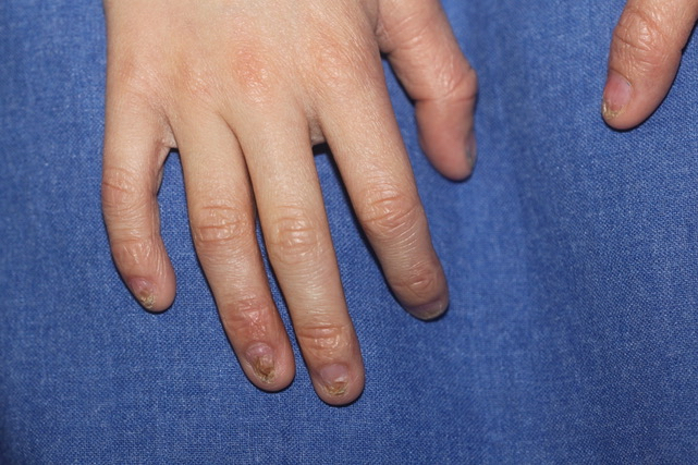 Showing Dystrophic nails affecting the fingers and toes.