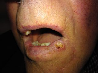 Figure 1: Carcinome épidermoïde de la lèvre inférieure avec une chéilite actinique en arrière plan. Les lèvres semblent sèches et craquelées avec une perte du bord vermillon. Une ulcération à bords éversés et indurés à la palpation est visible sur la lèvre inférieure gauche.