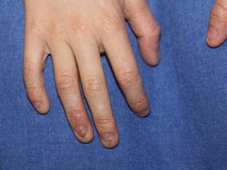 Showing Dystrophic nails affecting the fingers and toes.