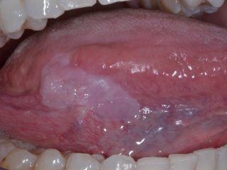Figura 1: Leucoplasia homogénea presente no bordo lateral direito da língua.
