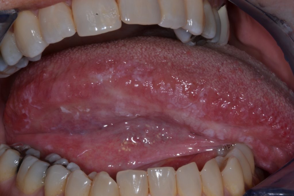 Figure 5: Non-homogenous leukoplakia involving the encompassing largely the right lateral tongue with more prominent keratotic areas seen, not exophytic. 