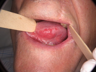 Figura 1: Eritroplasia disseminada afetando homogeneamente o bordo lateral esquerdo da língua e eritroplasia homogénea afetando homogeneamente a mucosa oral posterior direita.