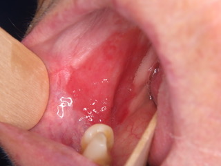 Figure 1: Widespread Erythroplakia homogenously affecting the left lateral border of the tongue and homogenous erythroplakia homogenously affecting the right buccal mucosa posteriorly. 