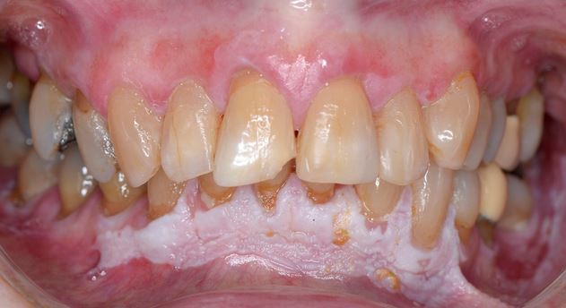 Figure 1: LVP dense affectant la gencive vestibulaire antérieure à la mandibule, avec des composants nodulaires, une plaque mouchetée est également visible dans le sillon buccal mandibulaire gauche.