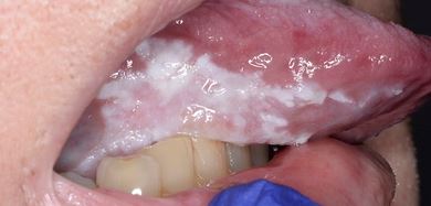 Figure 3: A dense multifocal area of PVL on the encompassing the right lateral tongue