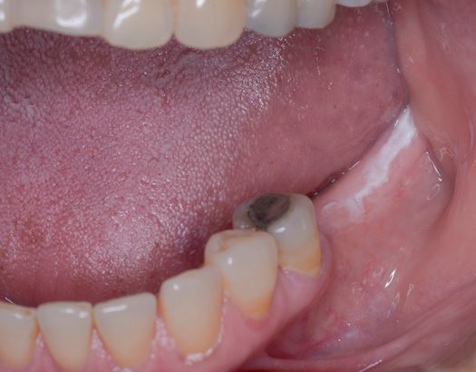 Figure 4 : LPV affectant la crête édentée postérieure mandibulaire gauche